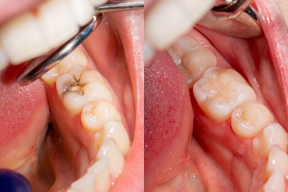 composite dental fillings in chino, california