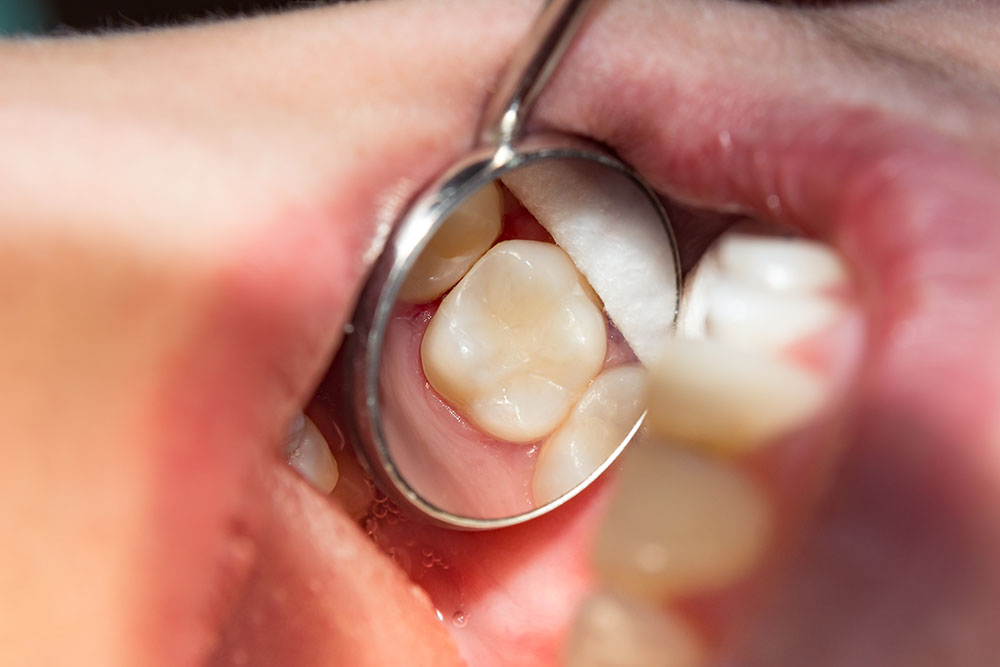 teeth of a dental office patient showing a filling