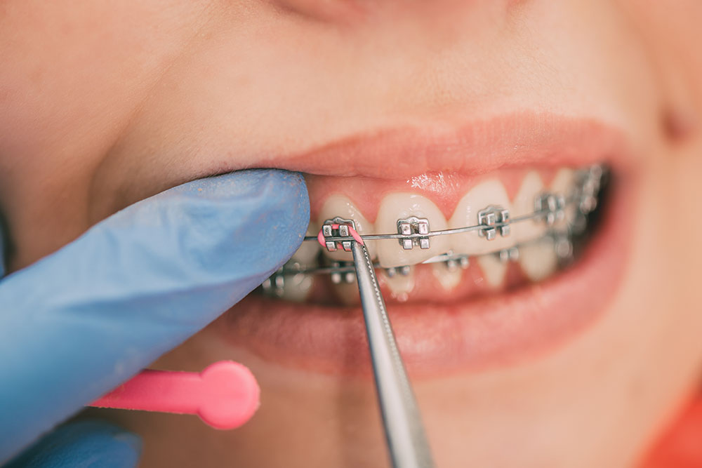 Dentist checking bracket at the braces on the female patient. Close-up. Real People.