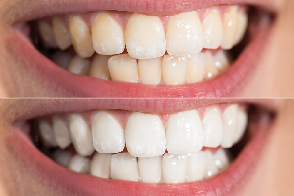Teeth Whitening Before After